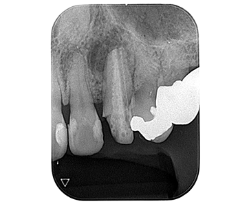 1本の歯をインプラントにて修復