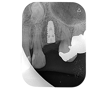 1本の歯をインプラントにて修復