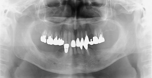 臼歯の欠損を入れ歯に代わりインプラントにて修復