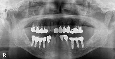 臼歯の欠損を入れ歯に代わりインプラントにて修復