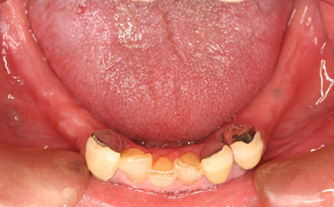 臼歯の欠損を入れ歯に代わりインプラントにて修復