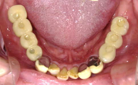 臼歯の欠損を入れ歯に代わりインプラントにて修復