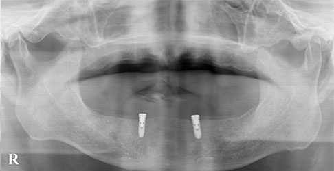 総入れ歯をインプラント・マグネットにより安定化を図った